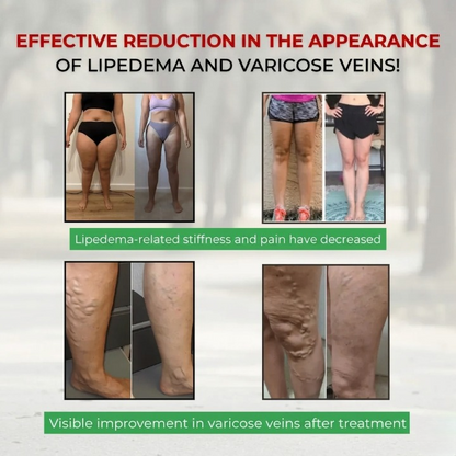 3-in-1 Leggings for Lipedema, Cellulite & Varicose Veins